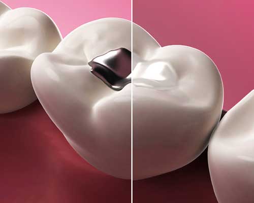 White Fillings | Grace Family Dental | Airdrie Dentist
